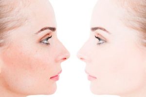 Lee más sobre el artículo ¿Cómo eliminar las imperfecciones en la cara?
